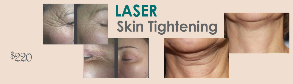 Skin Tightening  Kelowna Laser Spa